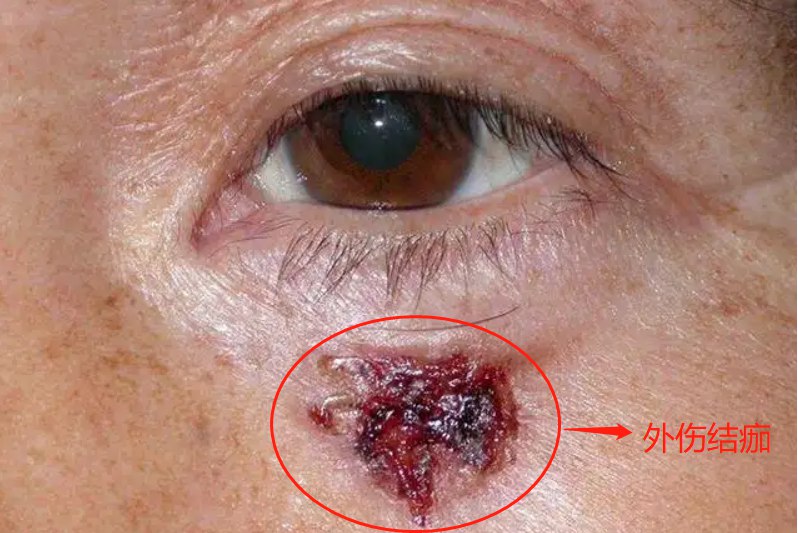 外伤结痂