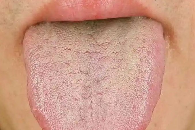湿热舌苔图片