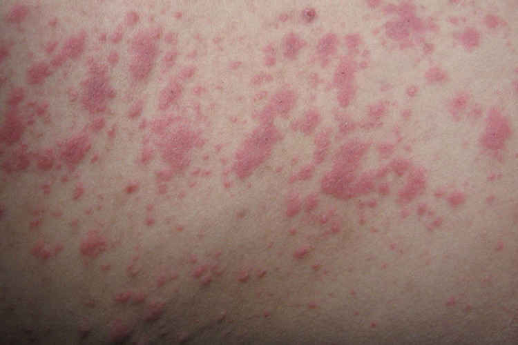 螨虫皮炎丘疹