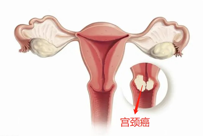 宫颈癌