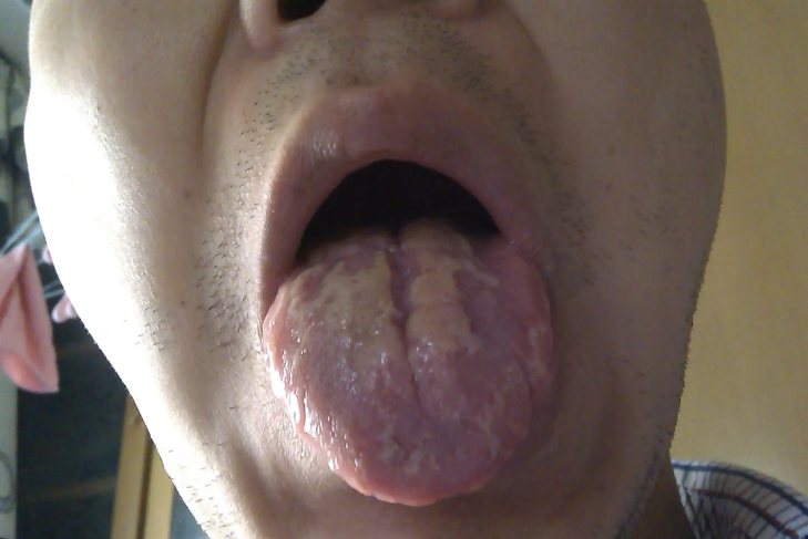 胃阴虚舌苔图片