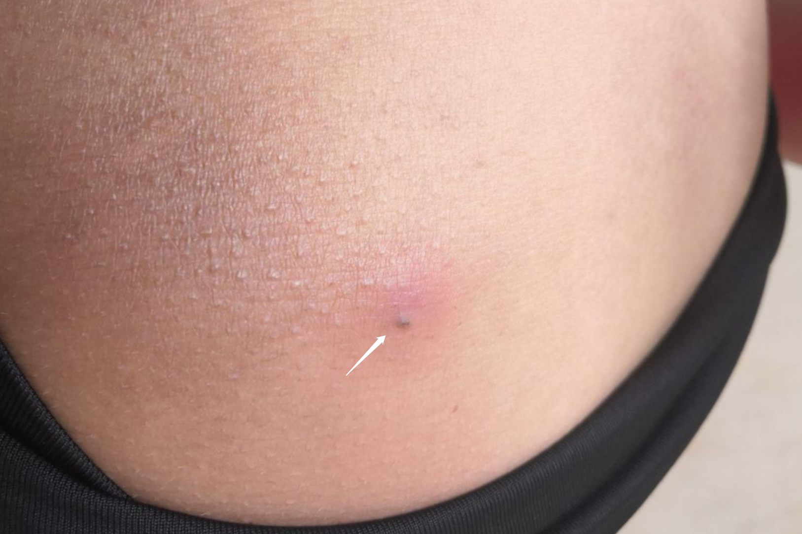 身上长疖子图片