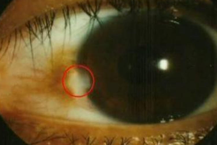 睑裂斑白色结节凸起图