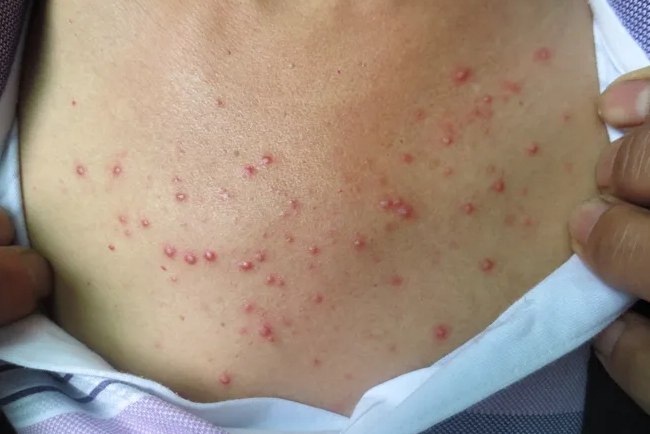 早期细菌性毛囊炎