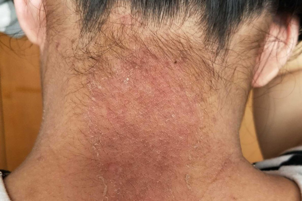 播散性神经性皮炎