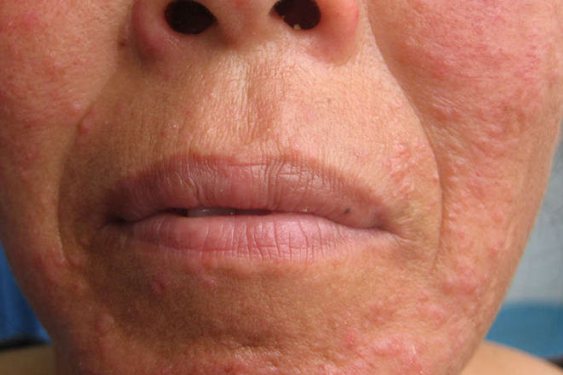 酒渣样或痤疮样皮炎