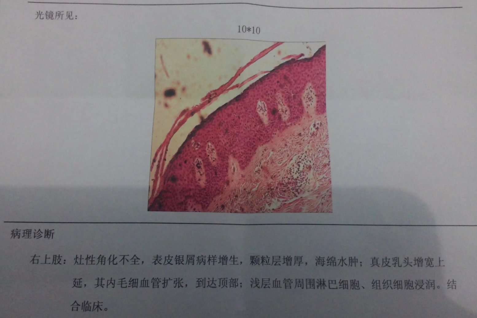 银屑病活检的病理报告图片