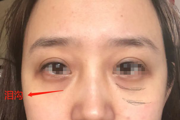 泪沟纹