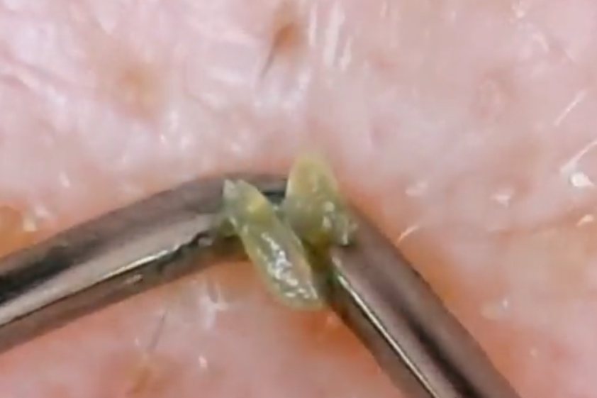 痘痘挤出来硬硬小米粒