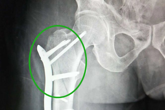 股骨转子间骨折