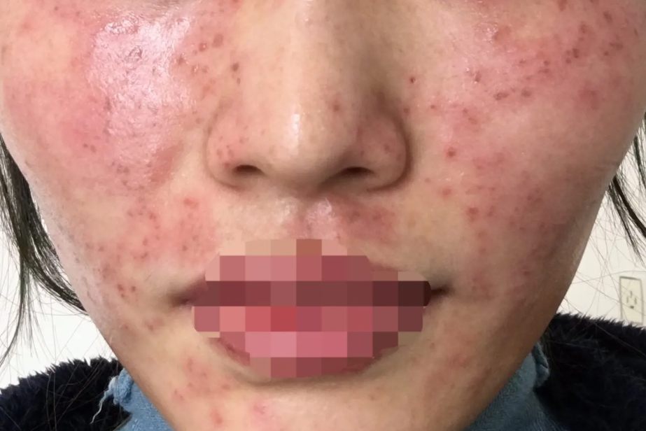 光子嫩肤祛斑脸上黑色结痂