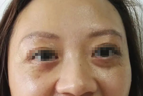 眶隔脂肪增多型