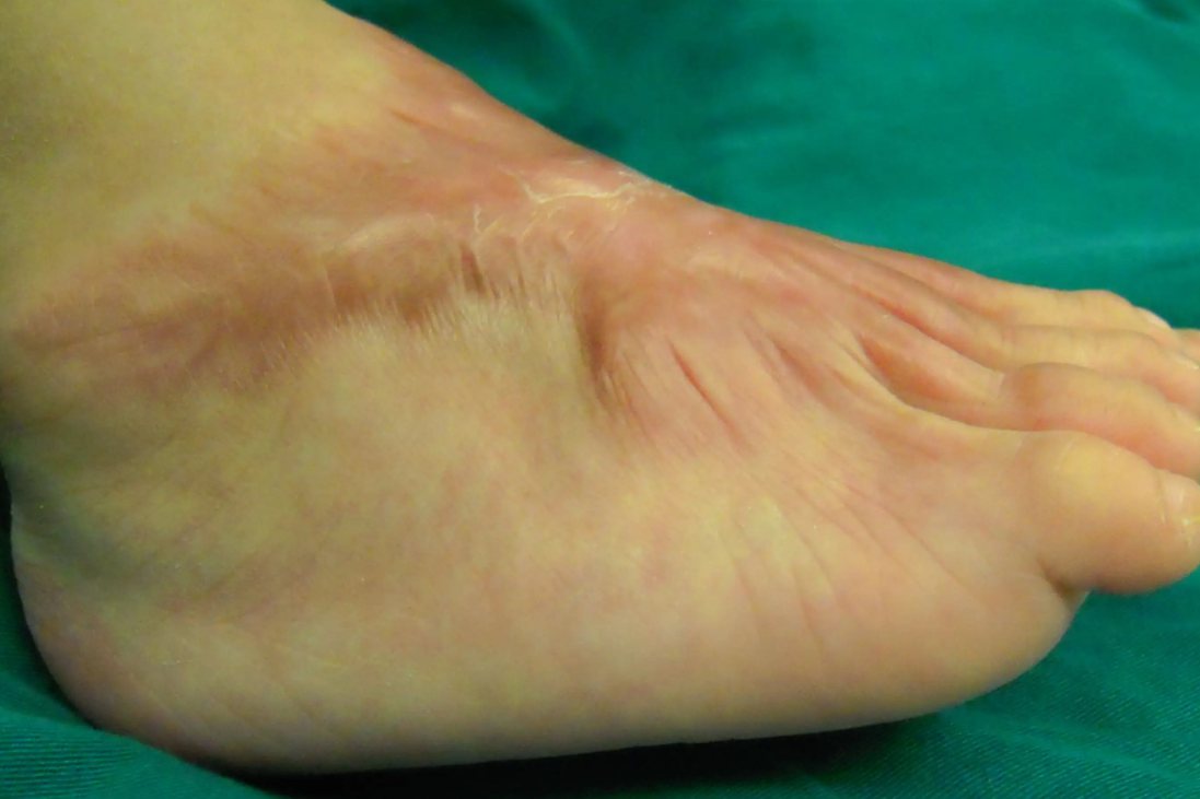 组织挛缩性凹陷疤痕