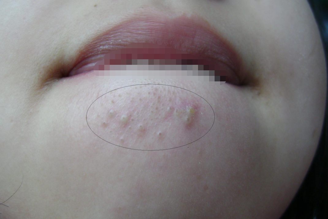 嘴唇上长脂肪粒