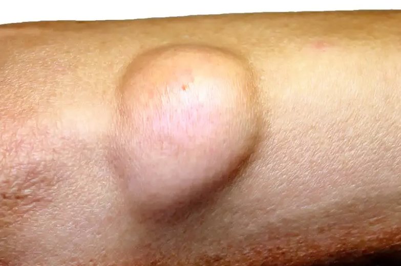 浅表皮下脂肪瘤