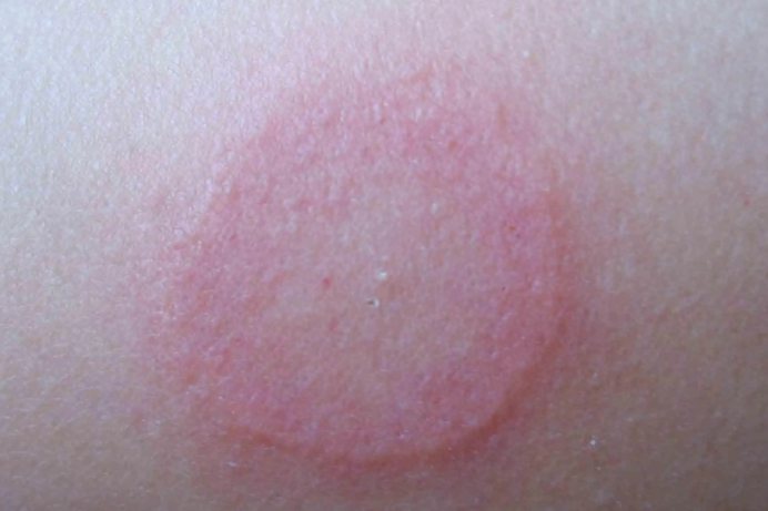 离心状环形红斑