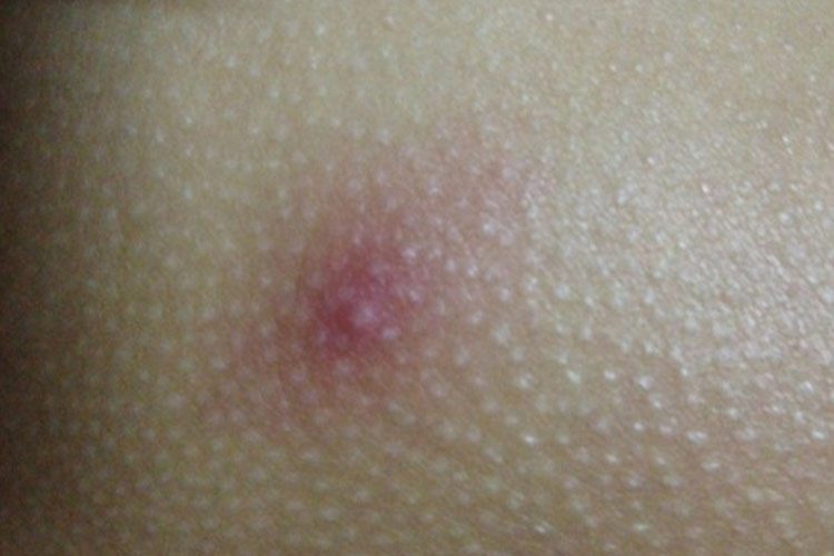 臀部的毛囊炎丘疹图