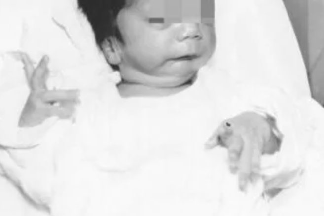 皮罗综合征症样貌