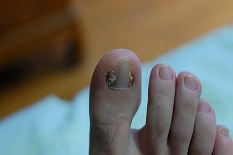 脚趾慢性甲沟炎图