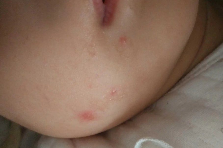 脸被跳蚤咬了