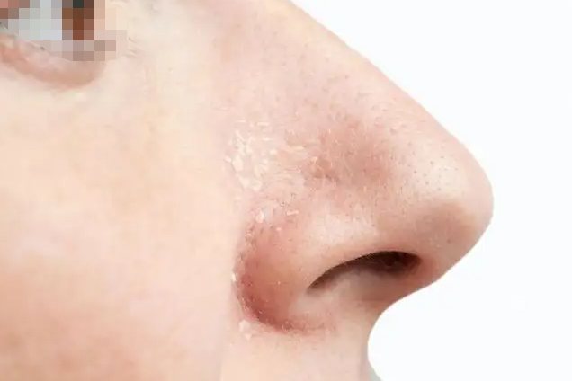 鼻翼两侧脱皮掉屑