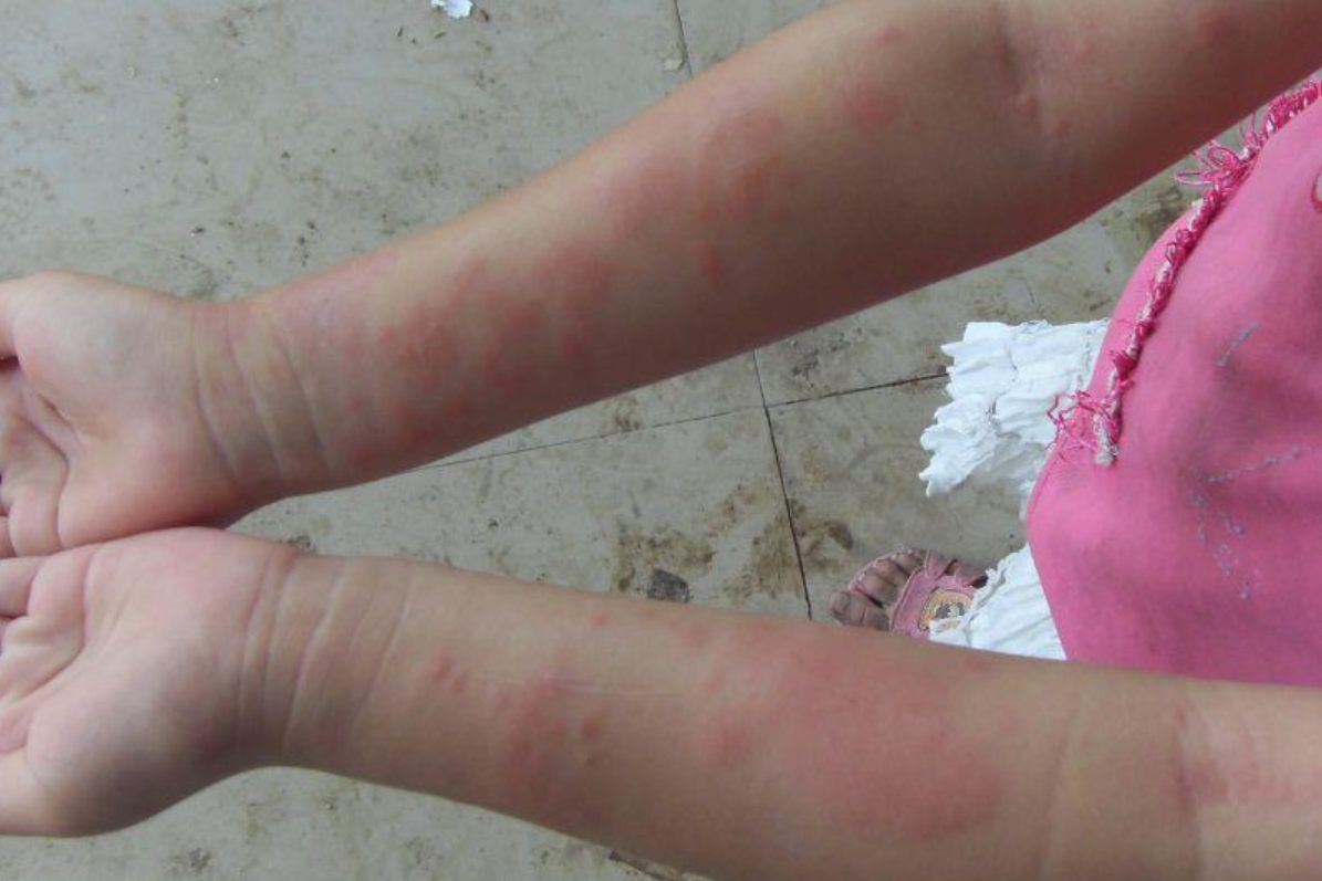 手部过敏性皮炎