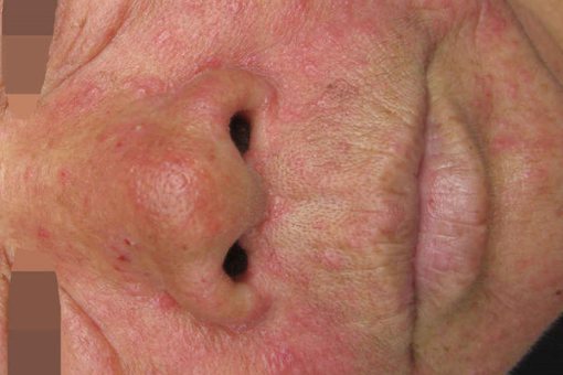 获得性色素减退斑