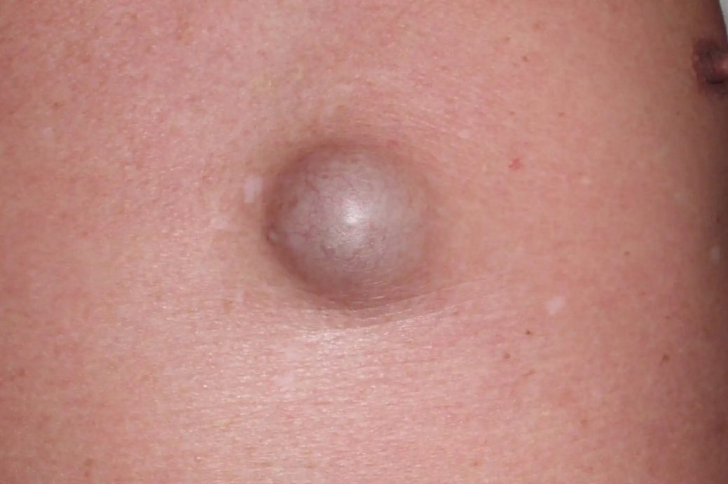 皮脂腺囊肿图片