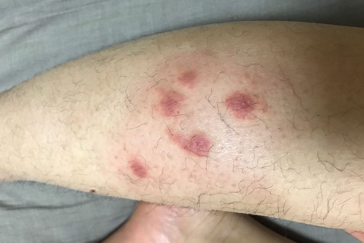 被蝽虫咬过的皮肤