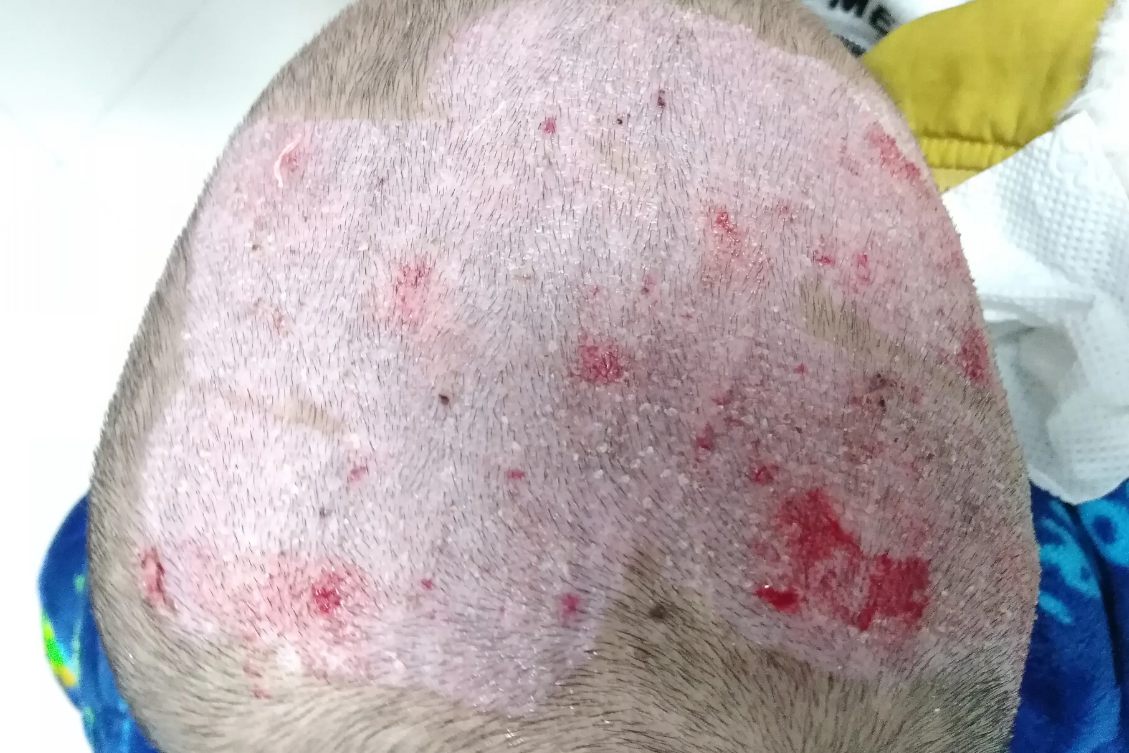 植皮取头皮后恢复照片