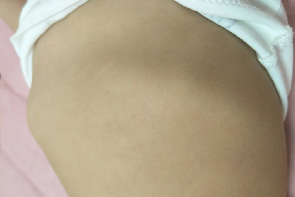 病理性肋骨外翻