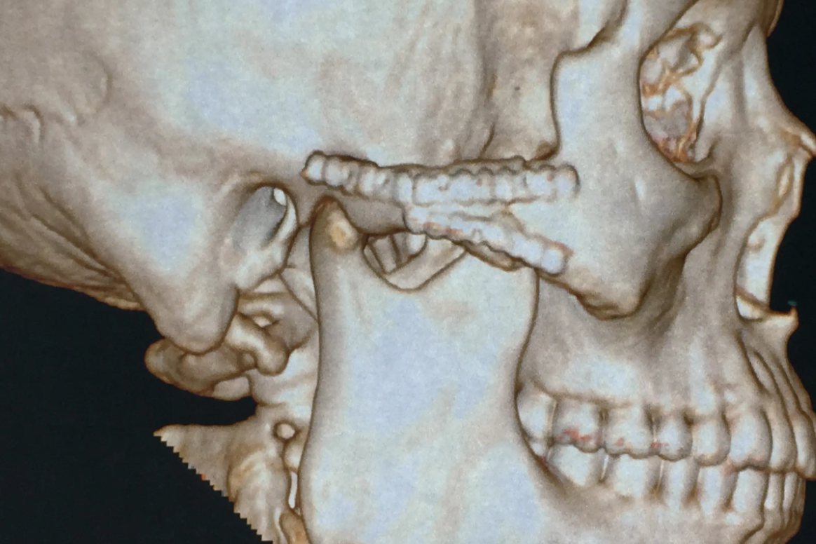 颧弓骨折不手术一年后图片