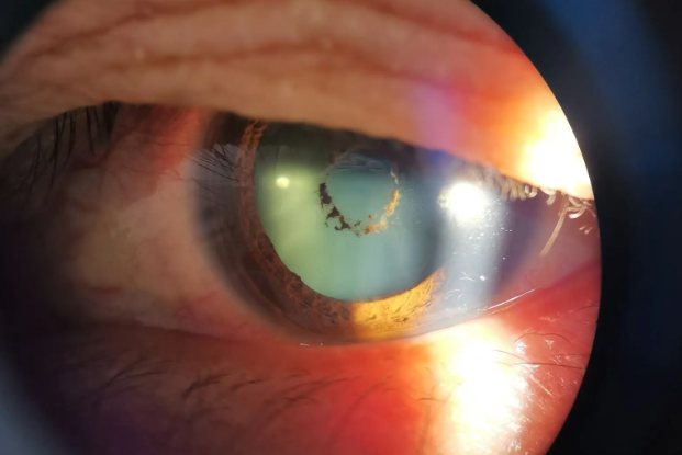 角膜白斑染色图