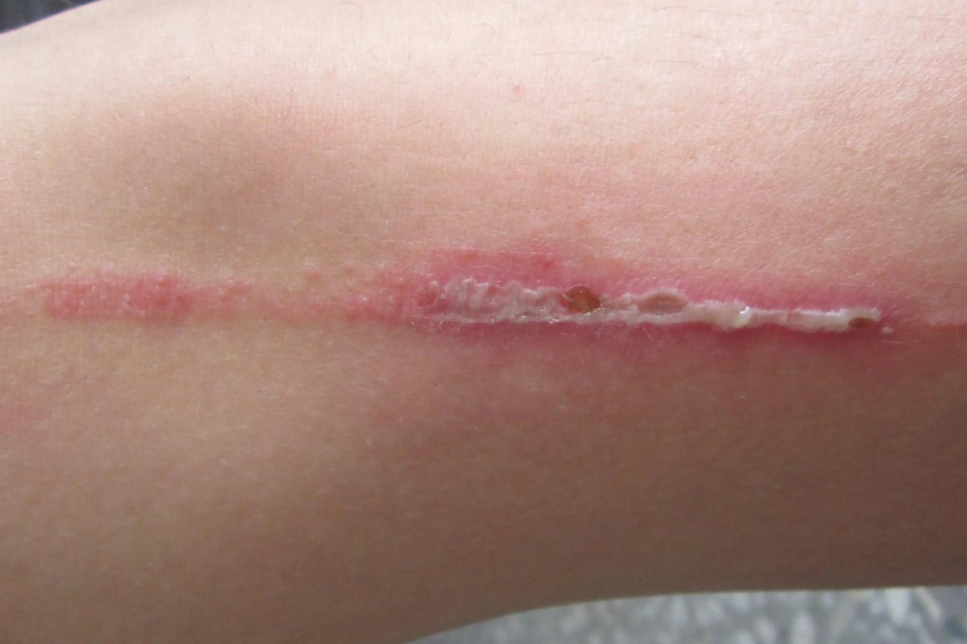 隐翅虫咬到初期