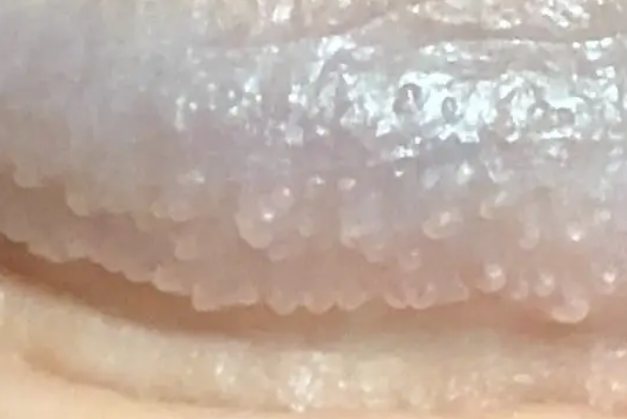 珍珠状阴茎丘疹