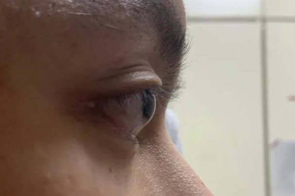 高度近视眼球突出