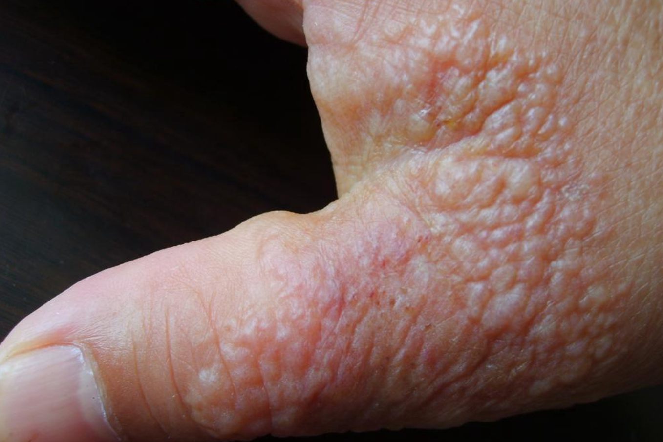 变应性接触性皮炎