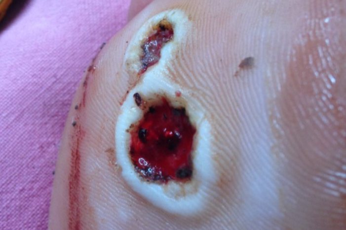 激光后伤口化脓图片