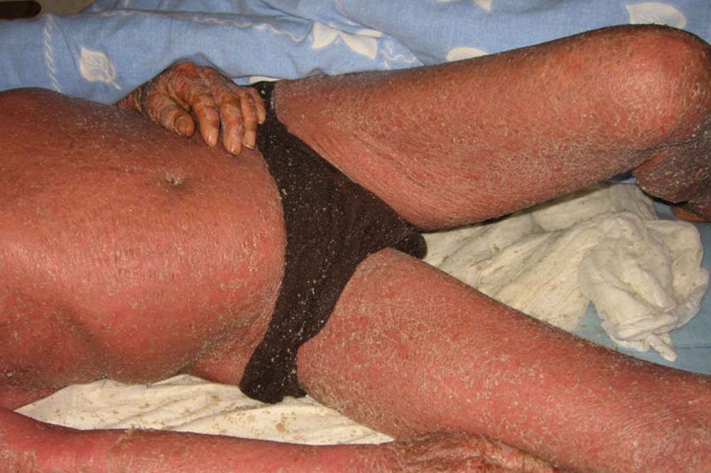 慢性脱屑性皮炎