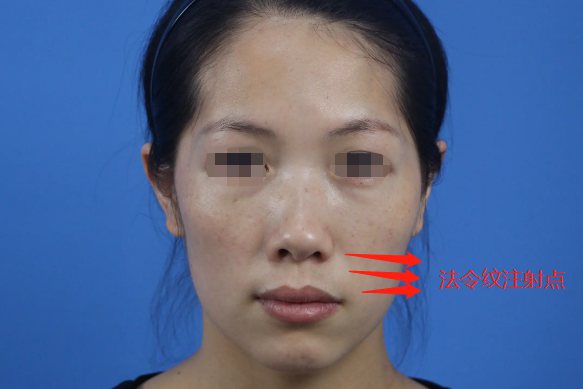 肉毒素去法令纹点位图
