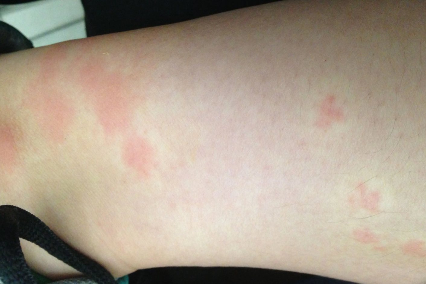 人被蓟马咬了的图片