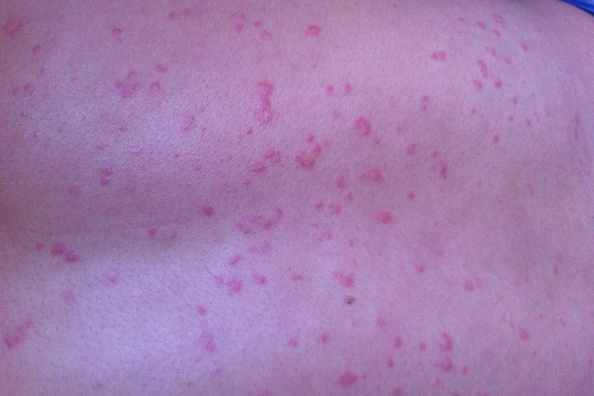 弥漫性血管内凝血