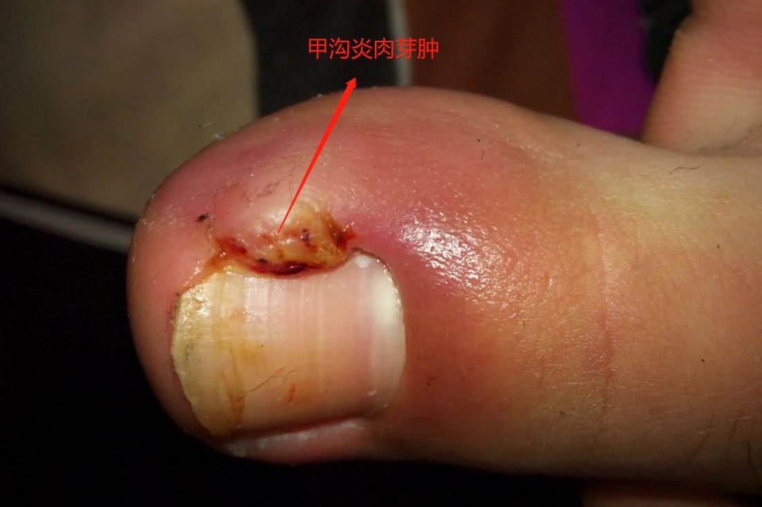 甲沟炎肉芽肿图片