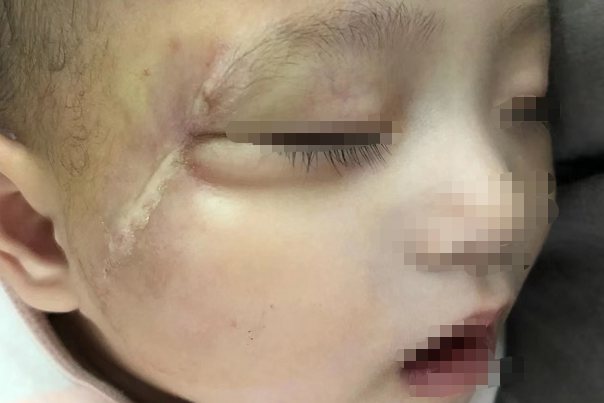 手术切除胎记图片