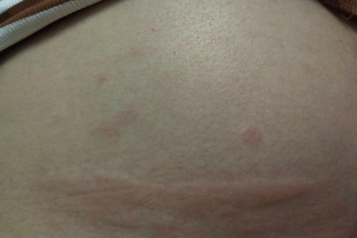 孕晚期妊娠荨麻疹