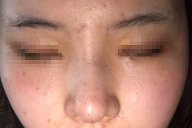 单纯隆鼻效果图片