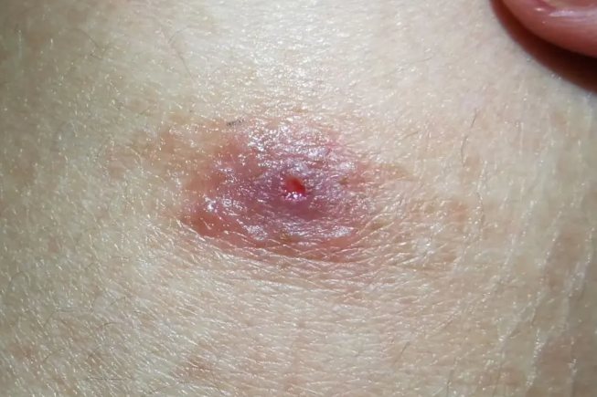 虱子叮咬后图片