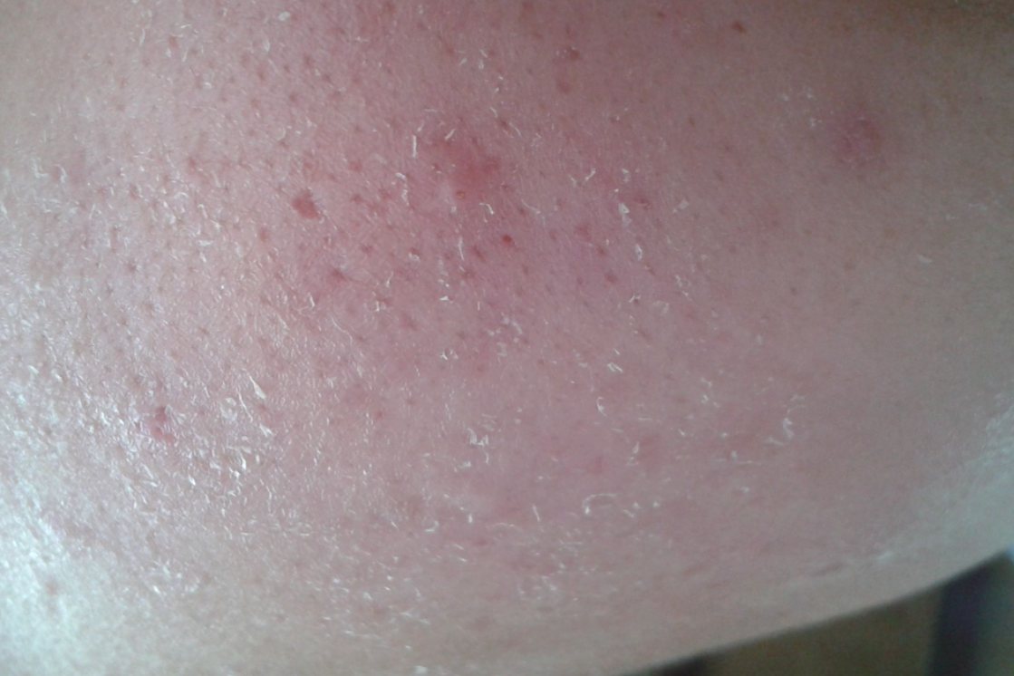 排色液用了脸掉皮