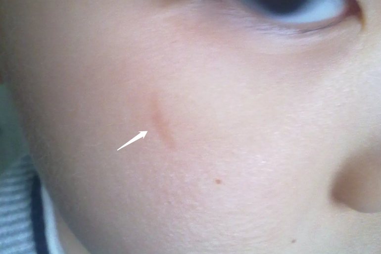 脸被指甲抓伤后的疤