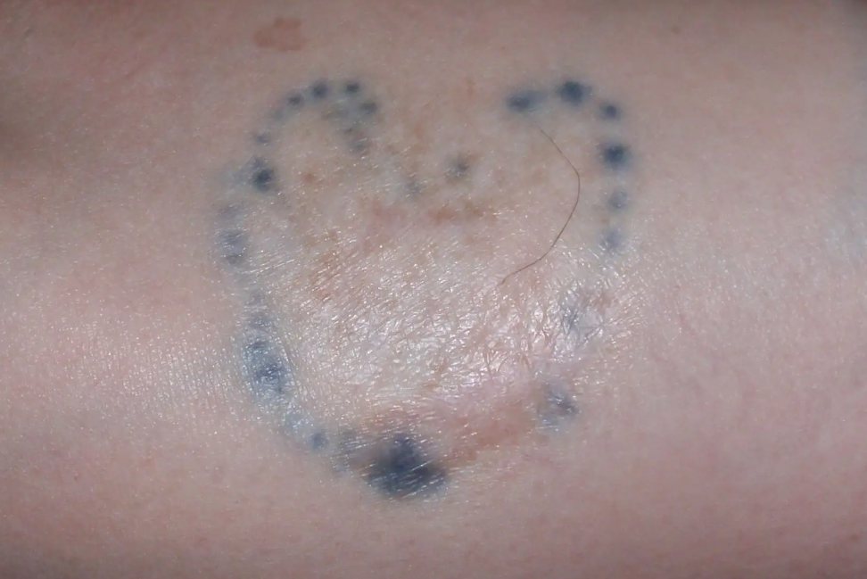 切除纹身后的疤痕